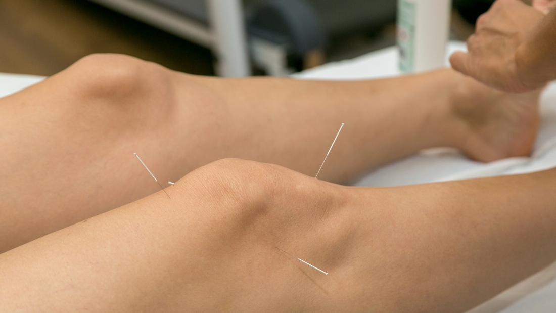 Adieux aux douleurs aux genoux grâce à l'acupuncture : un guide complet